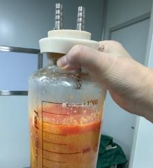邯郸水动力吸脂手术要做多久？